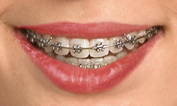 Lingual Braces Calgary: The Invisible Orthodontic Choice