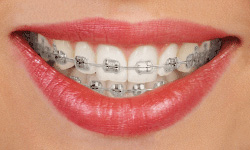 Lingual Braces Calgary: The Invisible Orthodontic Choice